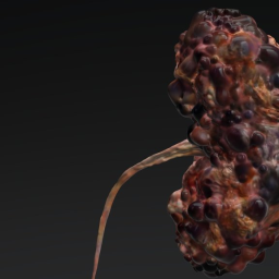 Polycystic kidney
