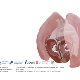 Transposition of the great arteries - open duct