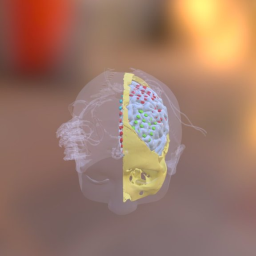 MRI-TC fusi&#243;n for epilepsy surgery planning