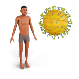 Measles
