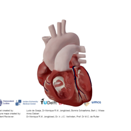Atrial Septal Defect (ASD)