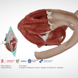 Transposition of the Great Arteries, Long Axis