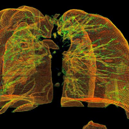 CT scan lung